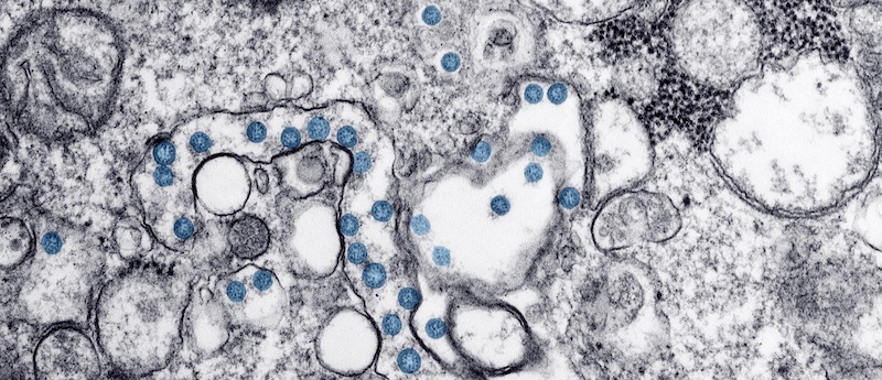 An Image From The First U.S. Case Of COVID-19, Formerly Known As 2019-nCoV.   [Image From The CDC]