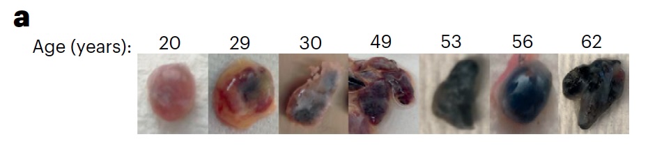 The effects of air pollution are easy to see in these lymph nodes from people of different ages.